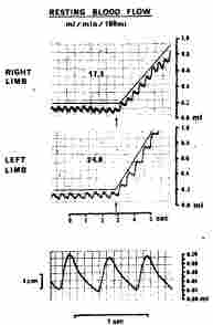 Limb plethysmography